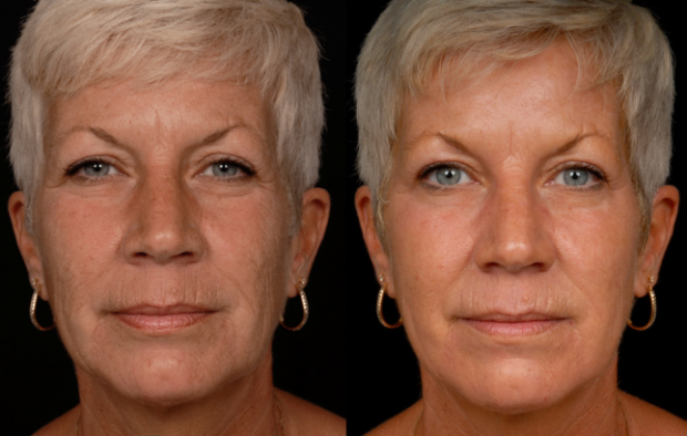 карбокситерапия фото до и после